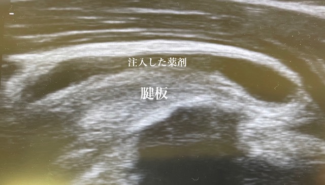 五十肩か腱板炎か?